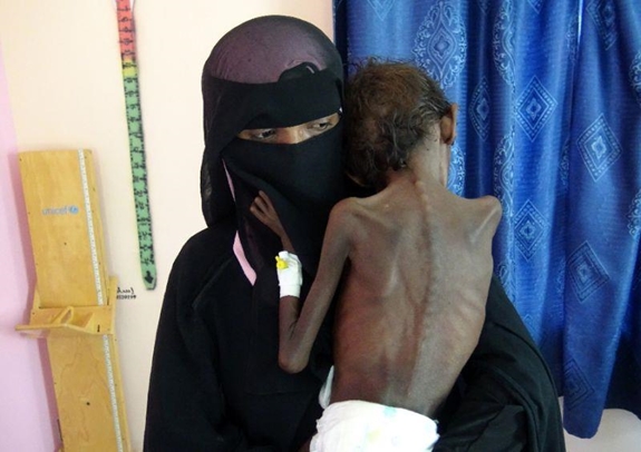 Trẻ em bị suy dinh dưỡng đang gia tăng ở Yemen do tình trạng nội chiến. Ảnh: AFP
